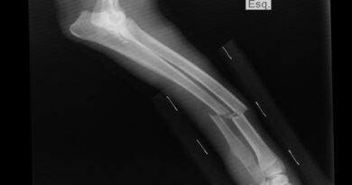 Bol u kostima kao upozorenje: kada je važno reagovati na vrijeme