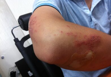 Zašto lako dobijate modrice i kako to može biti povezano sa vitaminima Zašto lako dobijate modrice i kako to može biti povezano sa vitaminima