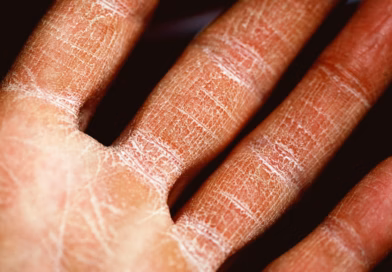 Ekcem (Atopijski dermatitis): simptomi, uzroci i kada potražiti pomoć