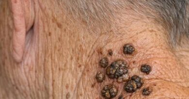 Tamne, voskaste izrasline na vratu kod starijih osoba: šta su i kada treba posetiti lekara?