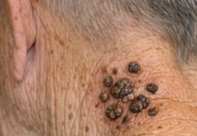 Tamne, voskaste izrasline na vratu kod starijih osoba: šta su i kada treba posetiti lekara? Tamne, voskaste izrasline na vratu kod starijih osoba: šta su i kada treba posetiti lekara?