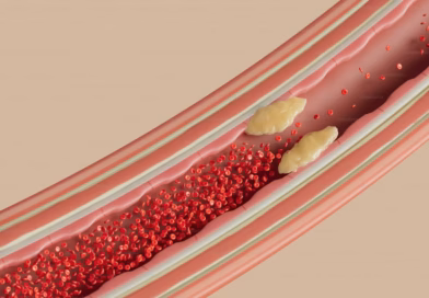 Nije mast, već šećer: Skriveni uzrok visokog holesterola i masne jetre