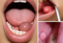 Kvržica u ustima: Kada je bezazlena, a kada treba otići kod stomatologa